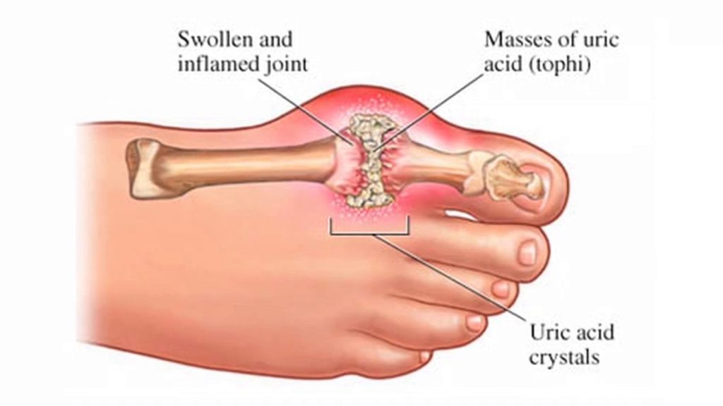 Symptoms Of High Uric Acid 3 Common Signs In Your Body