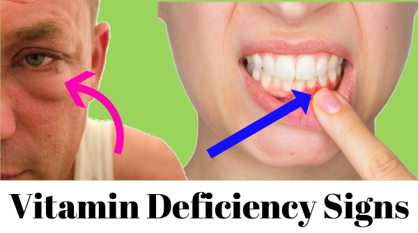 6 Physical signs of vitamin deficiency That You never ignore